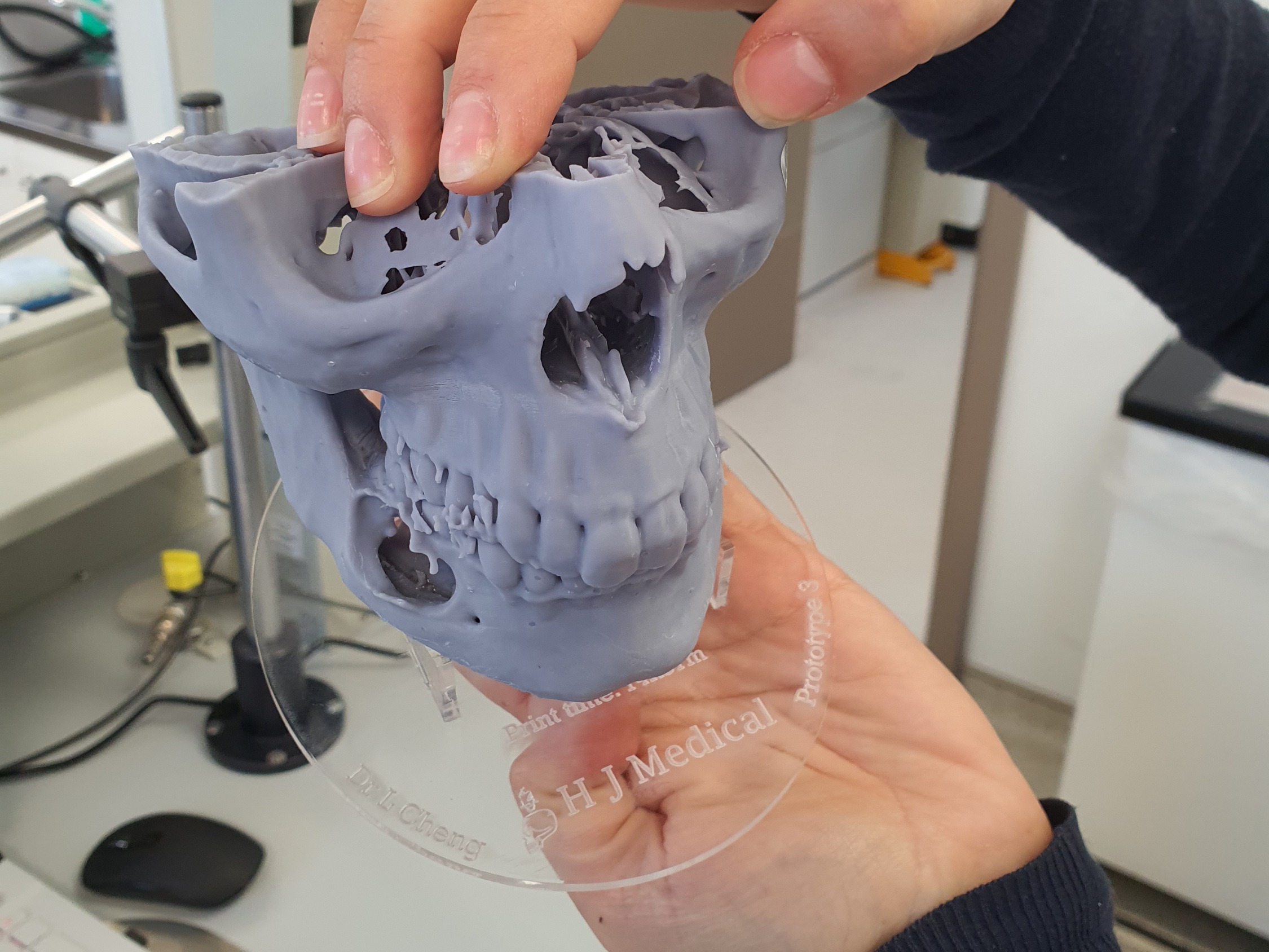 A 3D printed model of a patient's skull showing the odontogenic cyst